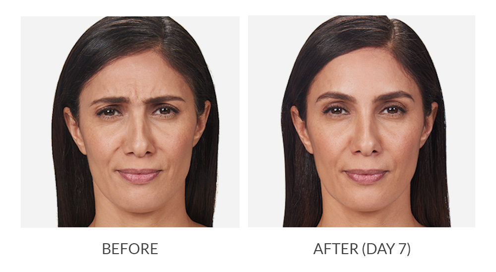 Before and after results for Botox Cosmetic