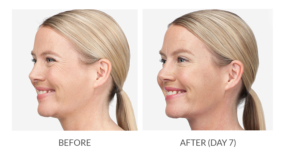 Before and after results for Botox Cosmetic