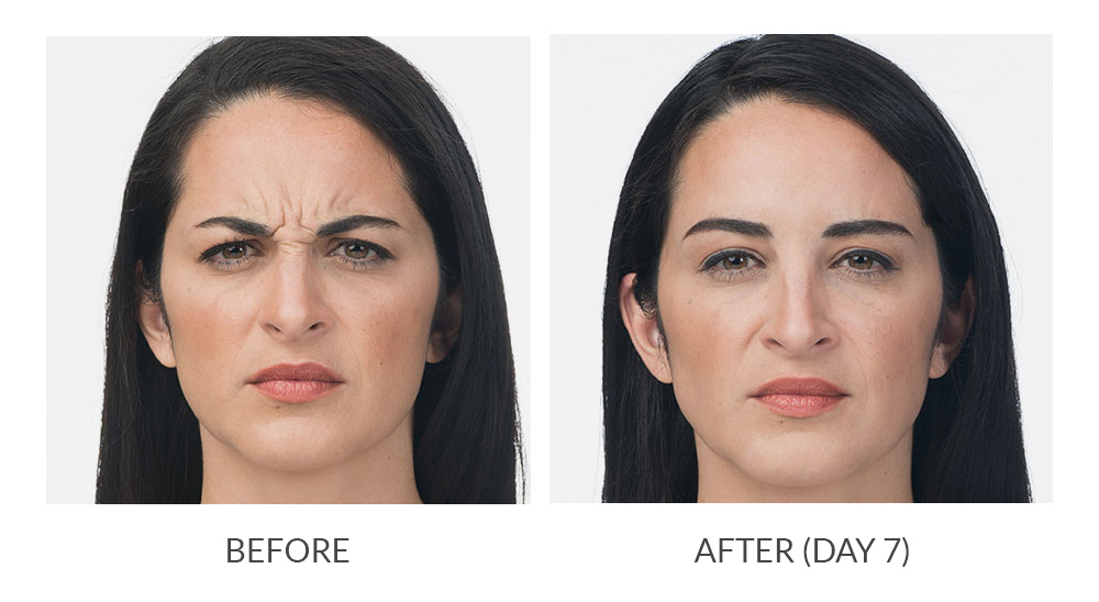 Before and after results for Botox Cosmetic