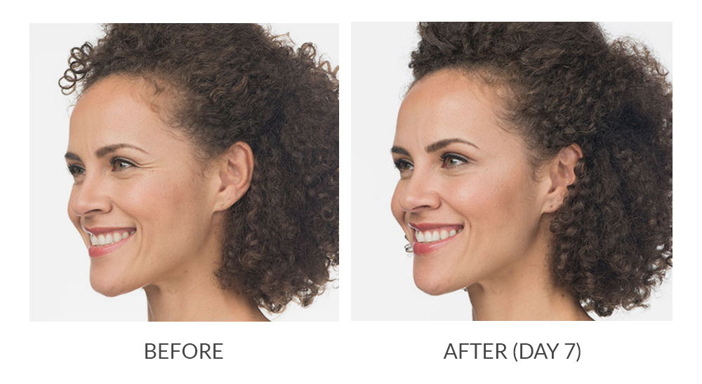Before and after results for Botox Cosmetic