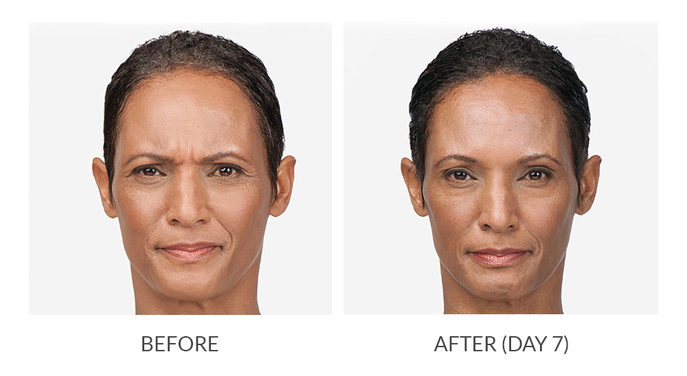 Before and after results for Botox Cosmetic