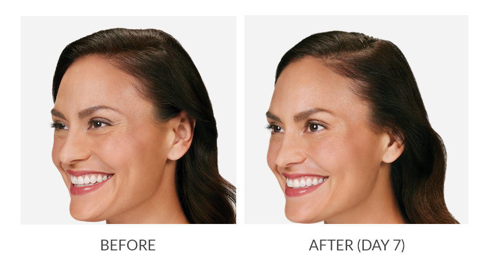 Before and after results for Botox Cosmetic