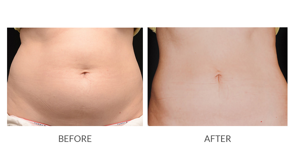 Before and after CoolSculpting results