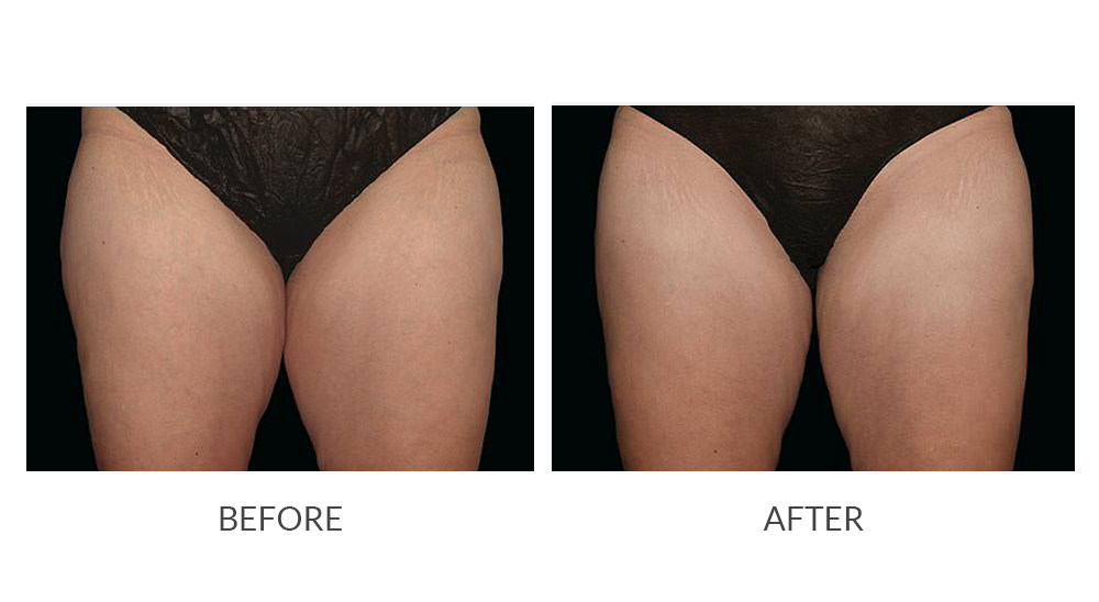 Before and after CoolSculpting results