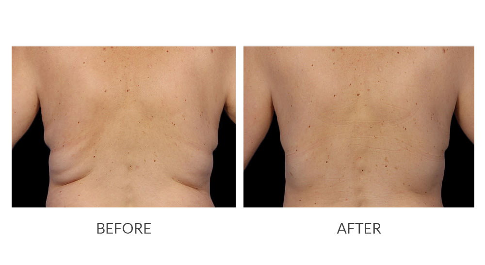 Before and after CoolSculpting results