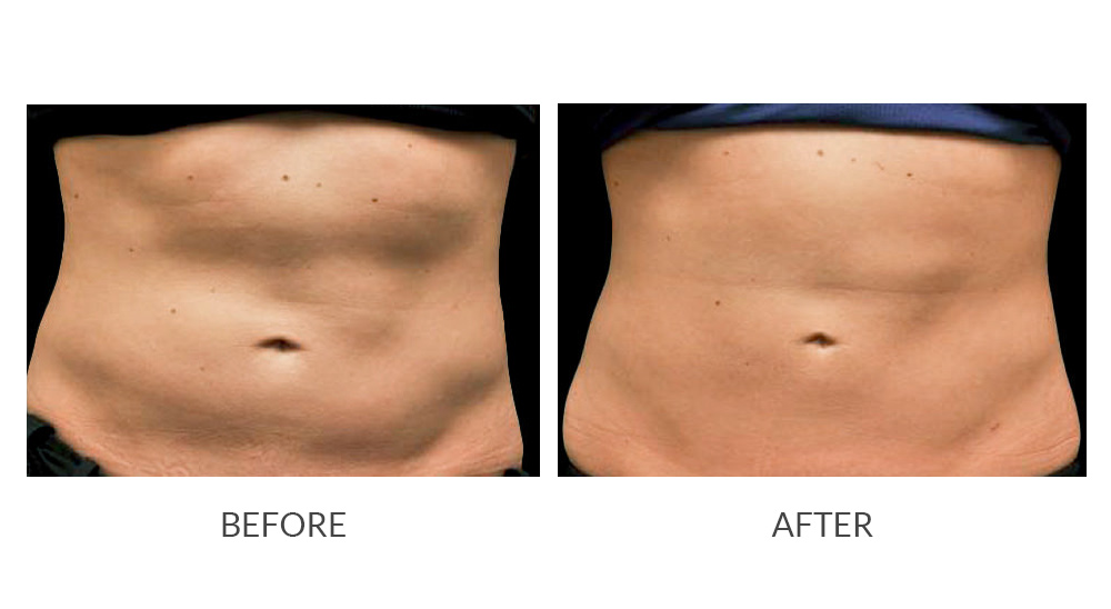 Before and after CoolSculpting results