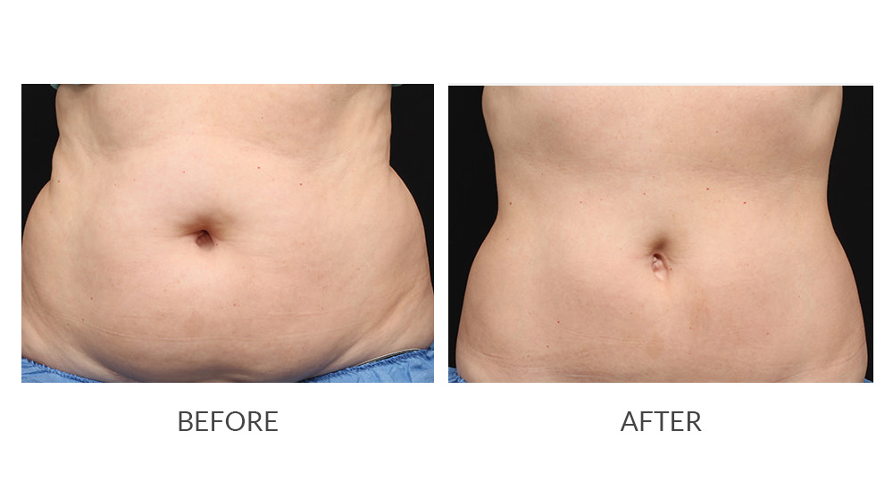 Before and after CoolSculpting results