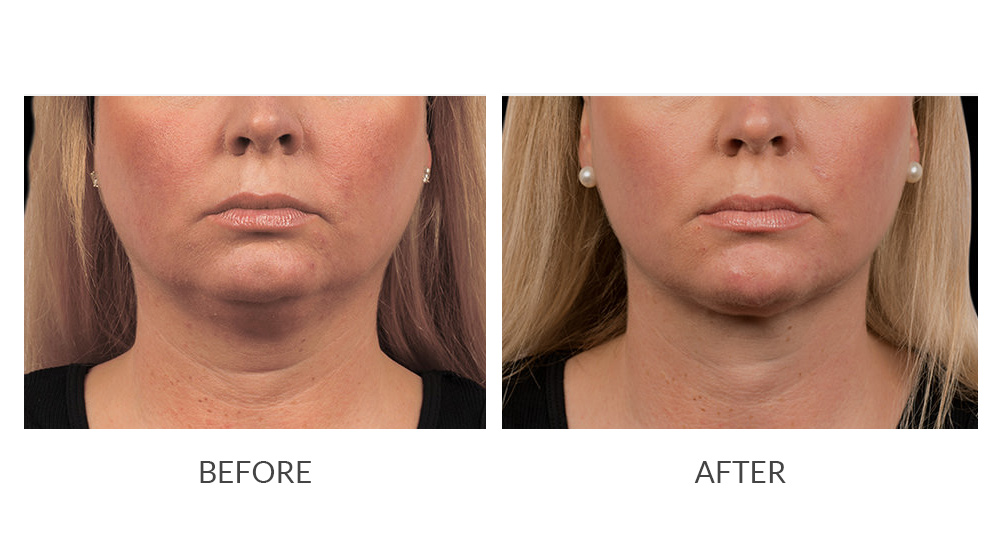 Before and after CoolSculpting results