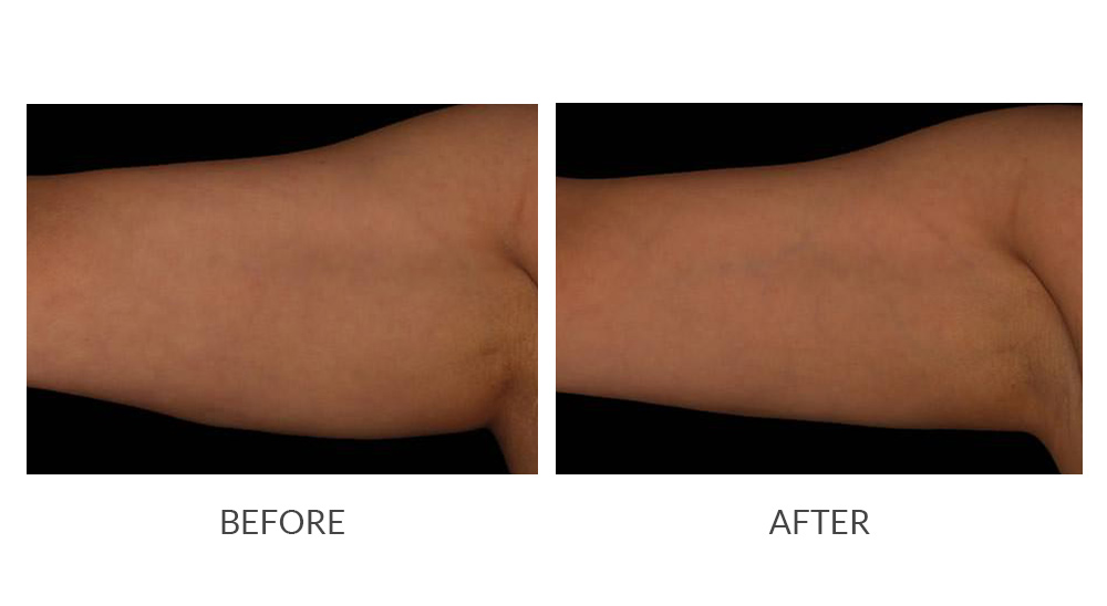 Before and after CoolSculpting results