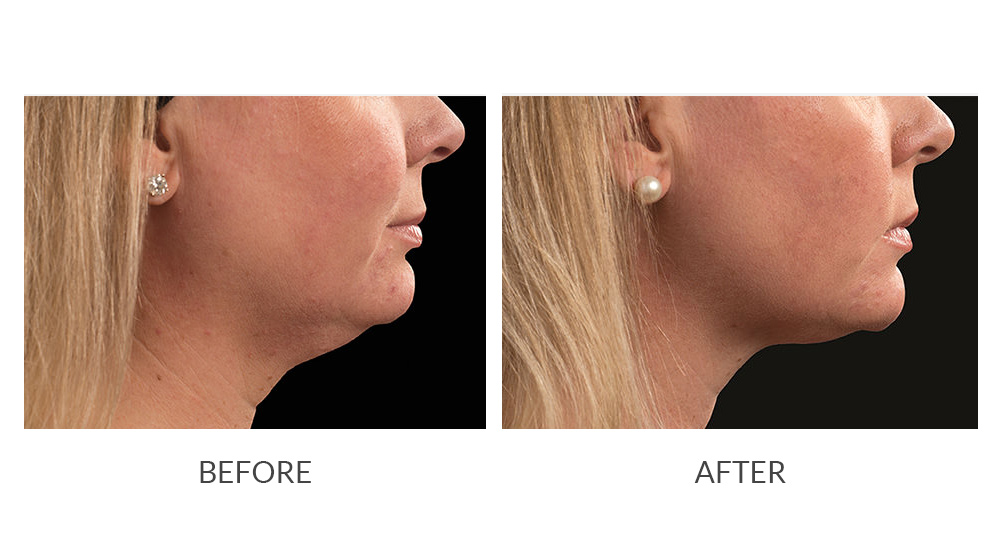 Before and after CoolSculpting results