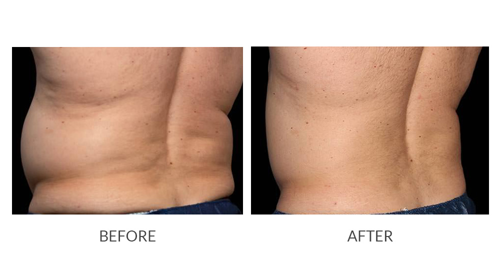 Before and after CoolSculpting results
