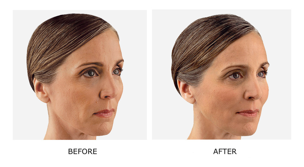 Before and after dermal fillers