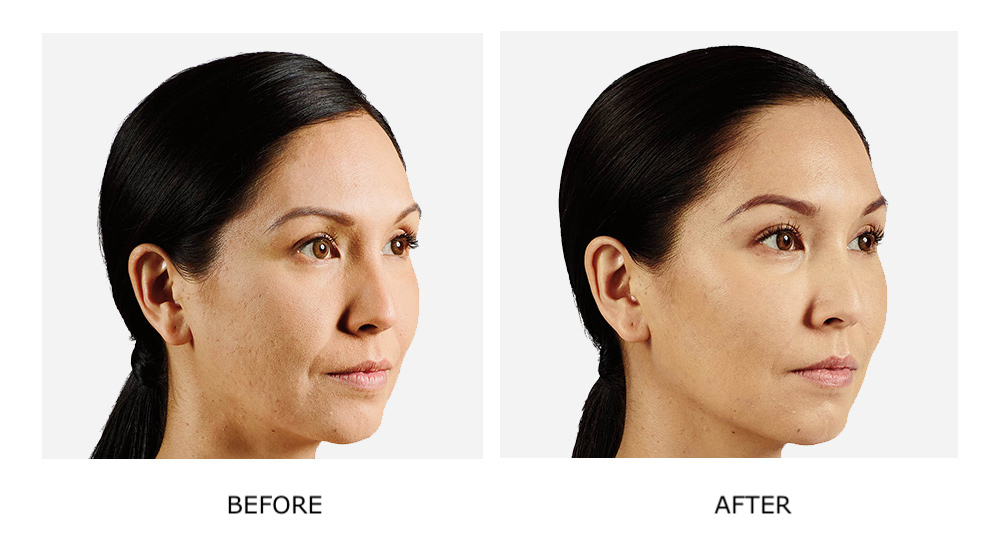 Before and after dermal fillers