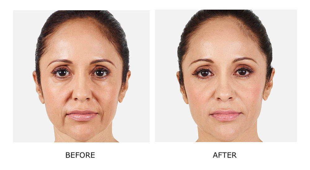 Before and after dermal fillers