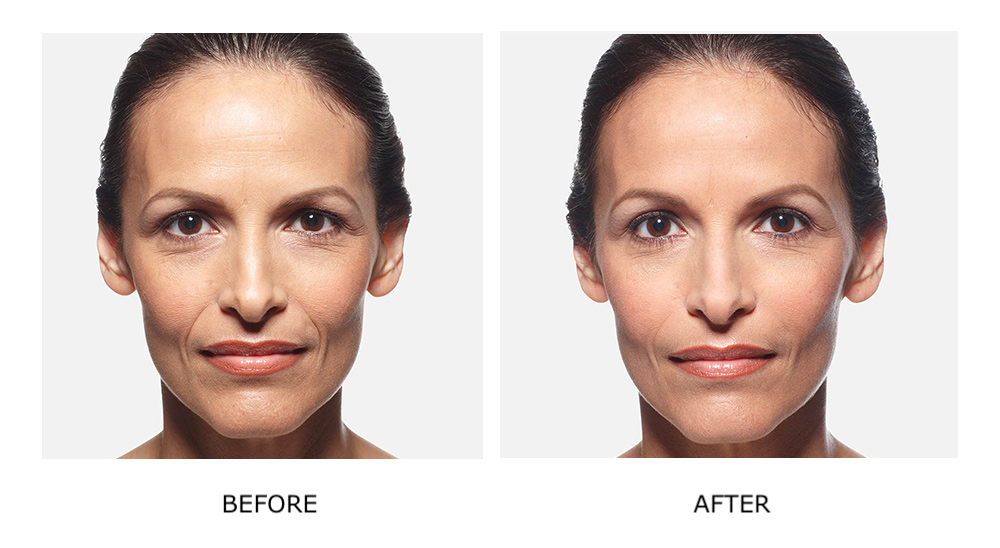 Before and after dermal fillers