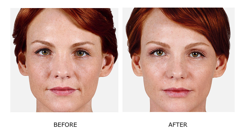 Before and after dermal fillers