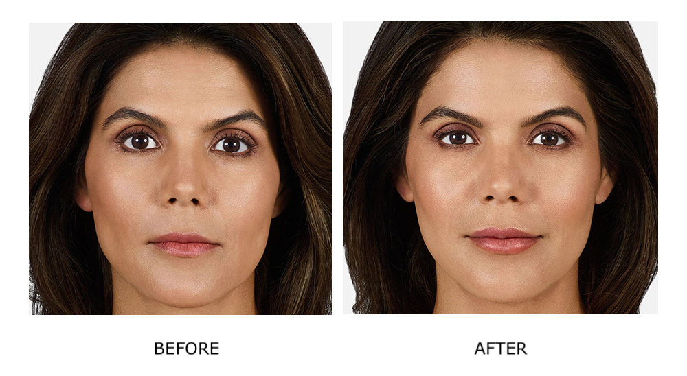 Before and after dermal fillers
