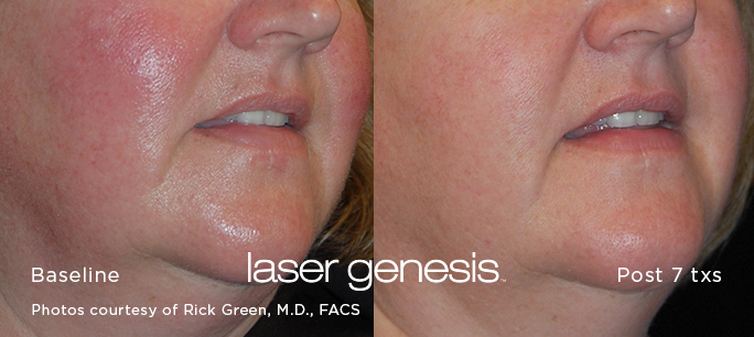 Before and after Laser Genesis treatments