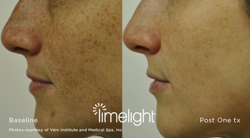 Before and after IPL skin therapy