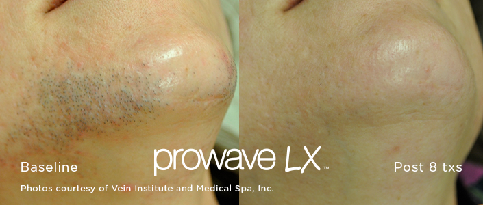 Before and after hair reduction therapy